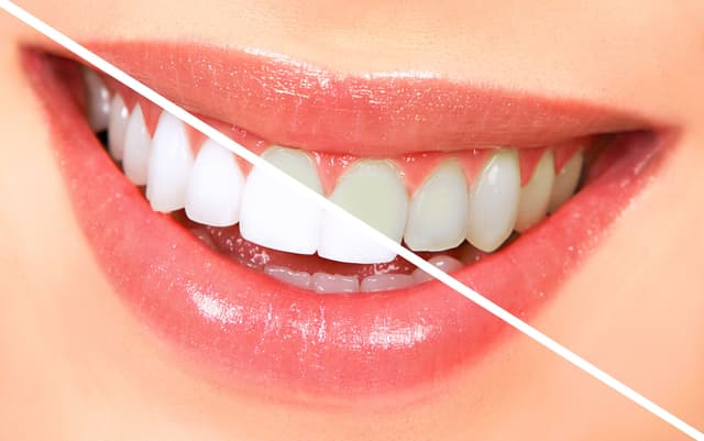 Teeth Whitening