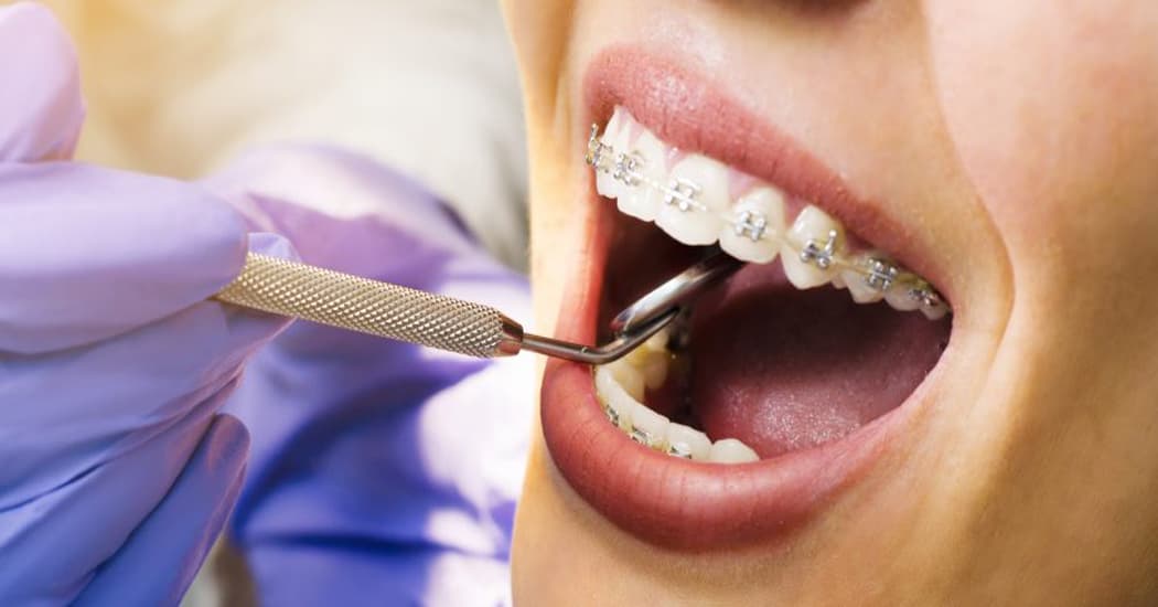 Braces Treatment