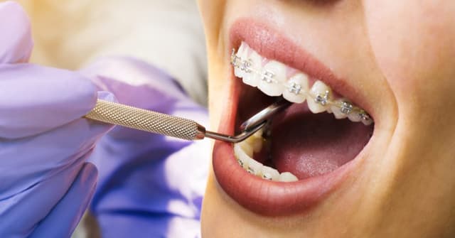 Braces Treatment