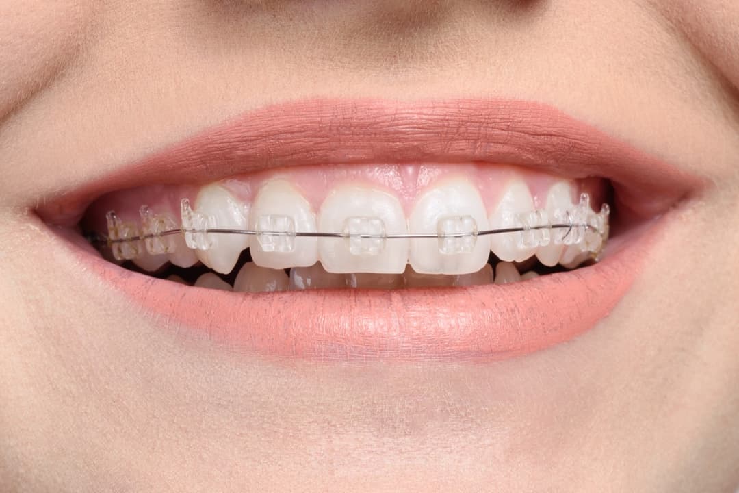 Ceramic Braces