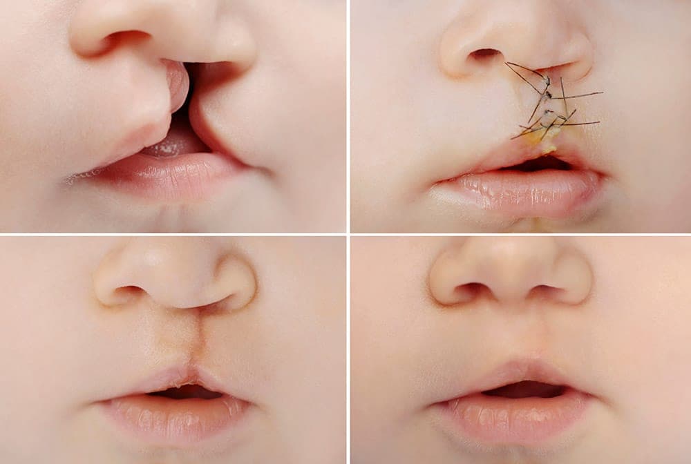 Cleft Lip & Palate
