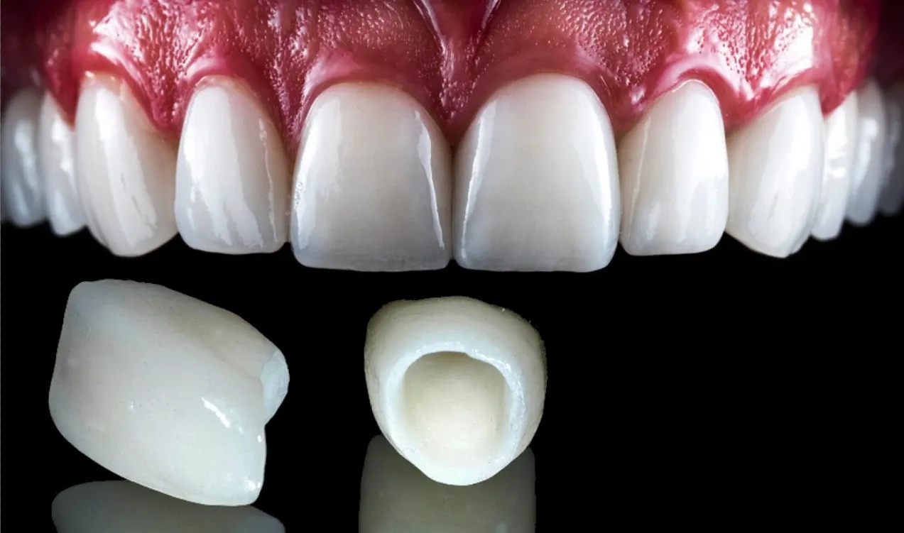 Porcelain / Zirconia Crowns