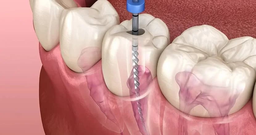 Root Canal Treatment