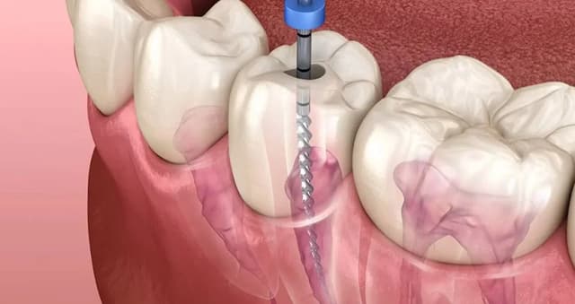 Root Canal