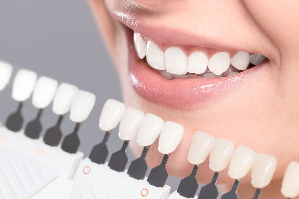 Composite / Porcelain / Zirconia Veneer