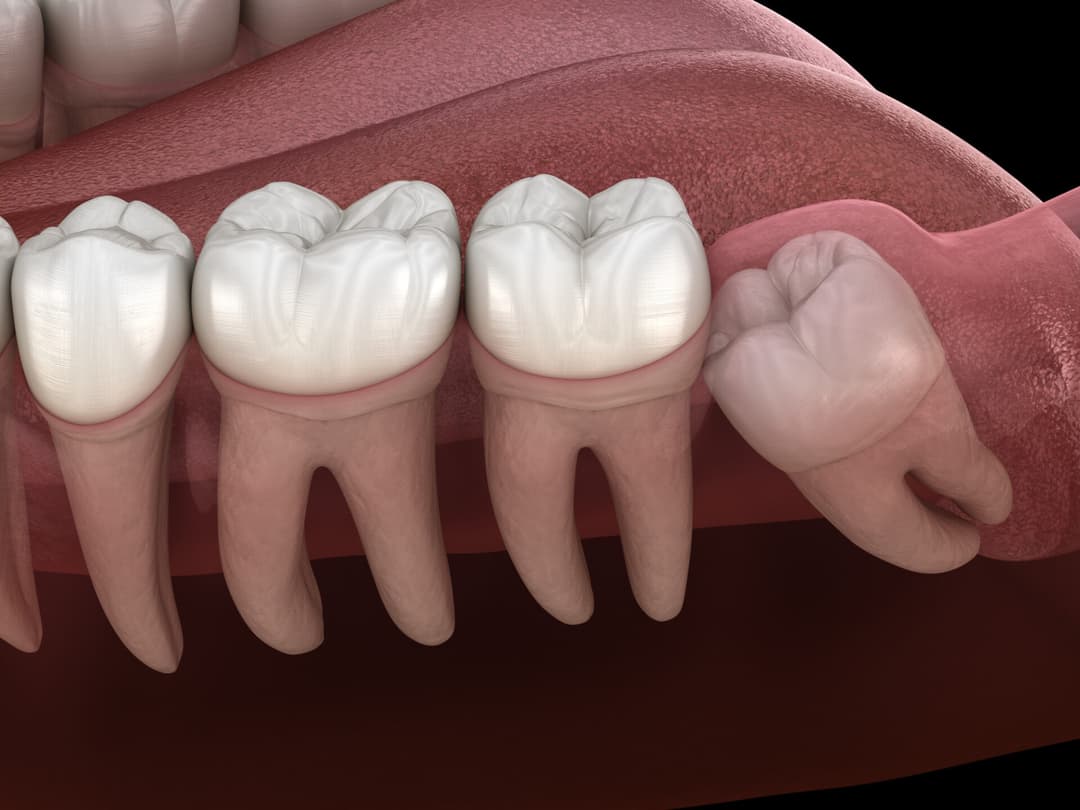 Wisdom Tooth Removal